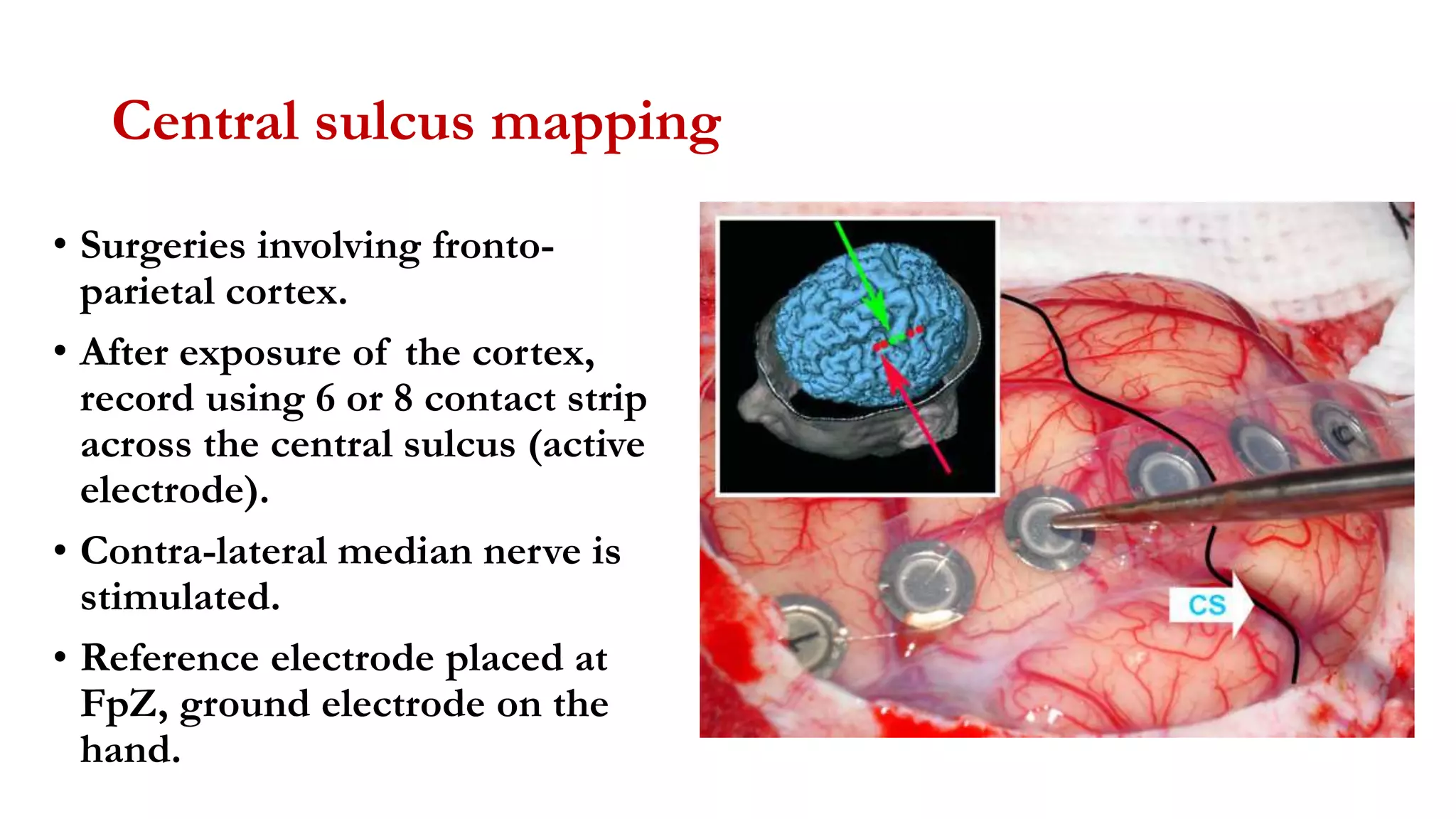 Central sulcus mapping
• Surgeries involving fronto-
parietal cortex.
• After exposure of the cortex,
record using 6 or 8 contact strip
across the central sulcus (active
electrode).
• Contra-lateral median nerve is
stimulated.
• Reference electrode placed at
FpZ, ground electrode on the
hand.
 
