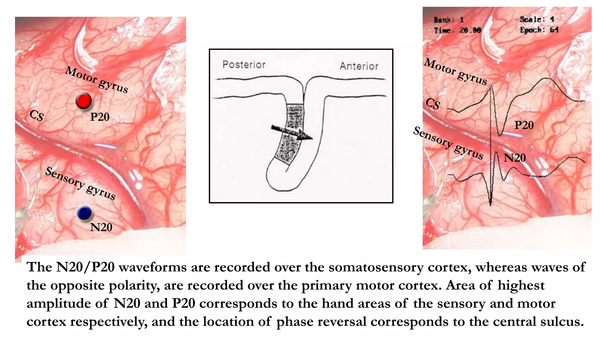 P20
N20
P20
N20
The N20/P20 waveforms are recorded over the somatosensory cortex, whereas waves of
the opposite polarity, are recorded over the primary motor cortex. Area of highest
amplitude of N20 and P20 corresponds to the hand areas of the sensory and motor
cortex respectively, and the location of phase reversal corresponds to the central sulcus.
 