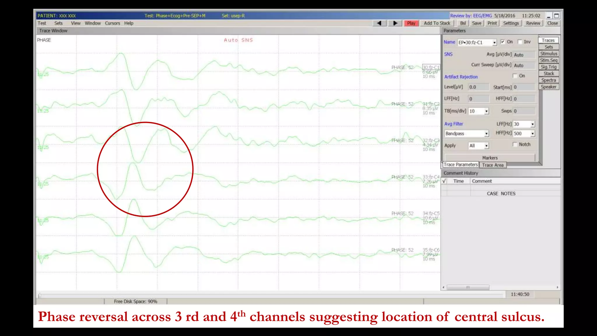 Phase reversal across 3 rd and 4th channels suggesting location of central sulcus.
 