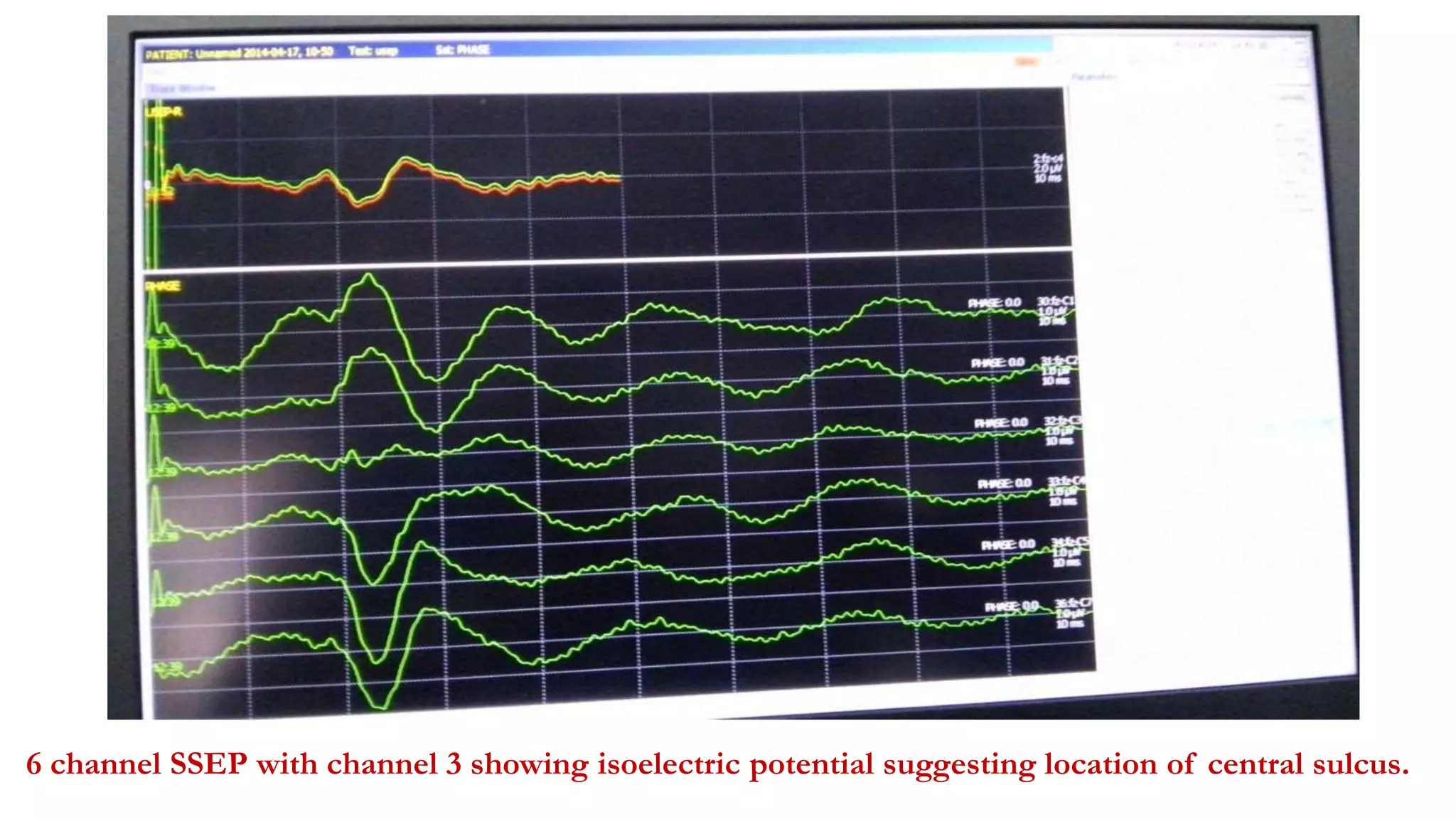 6 channel SSEP with channel 3 showing isoelectric potential suggesting location of central sulcus.
 