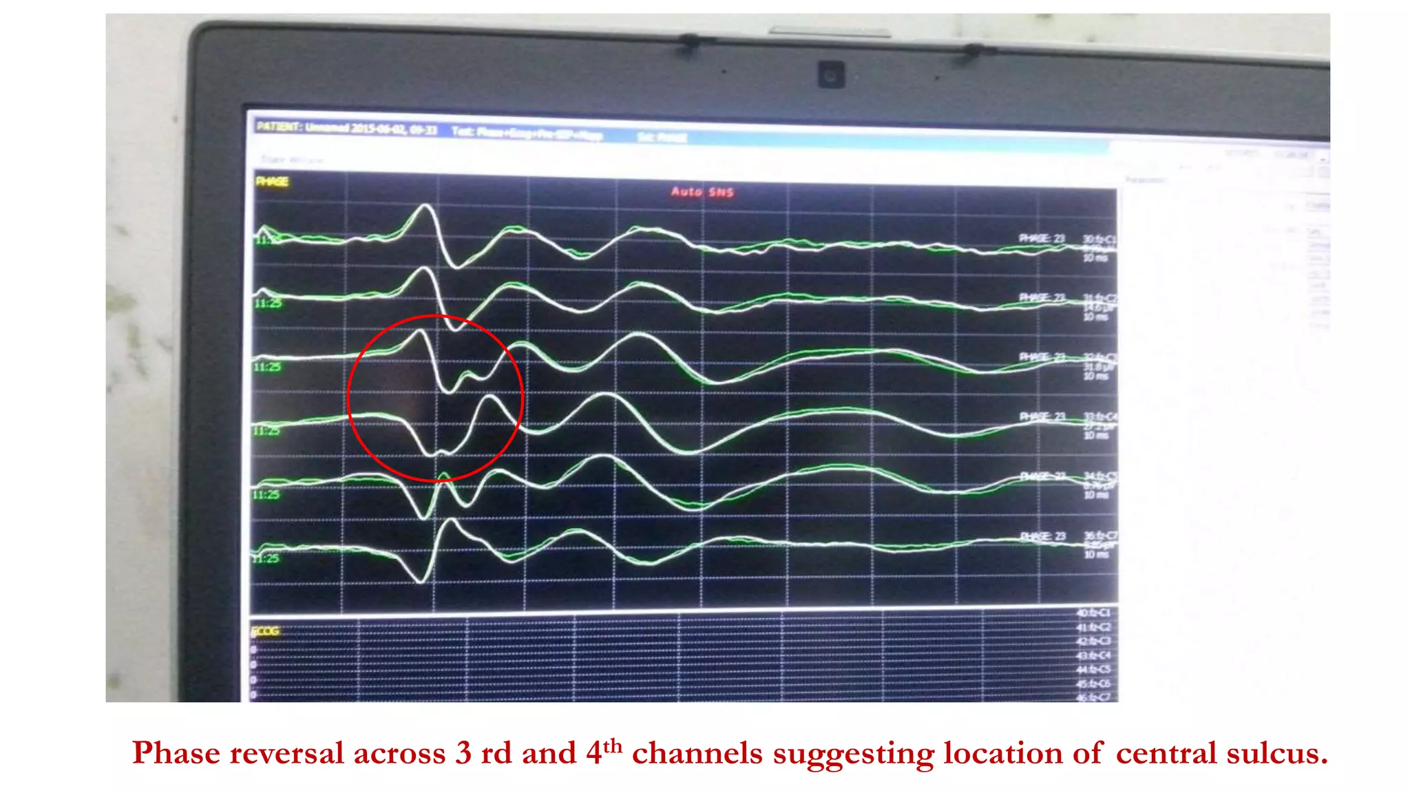 Phase reversal across 3 rd and 4th channels suggesting location of central sulcus.
 