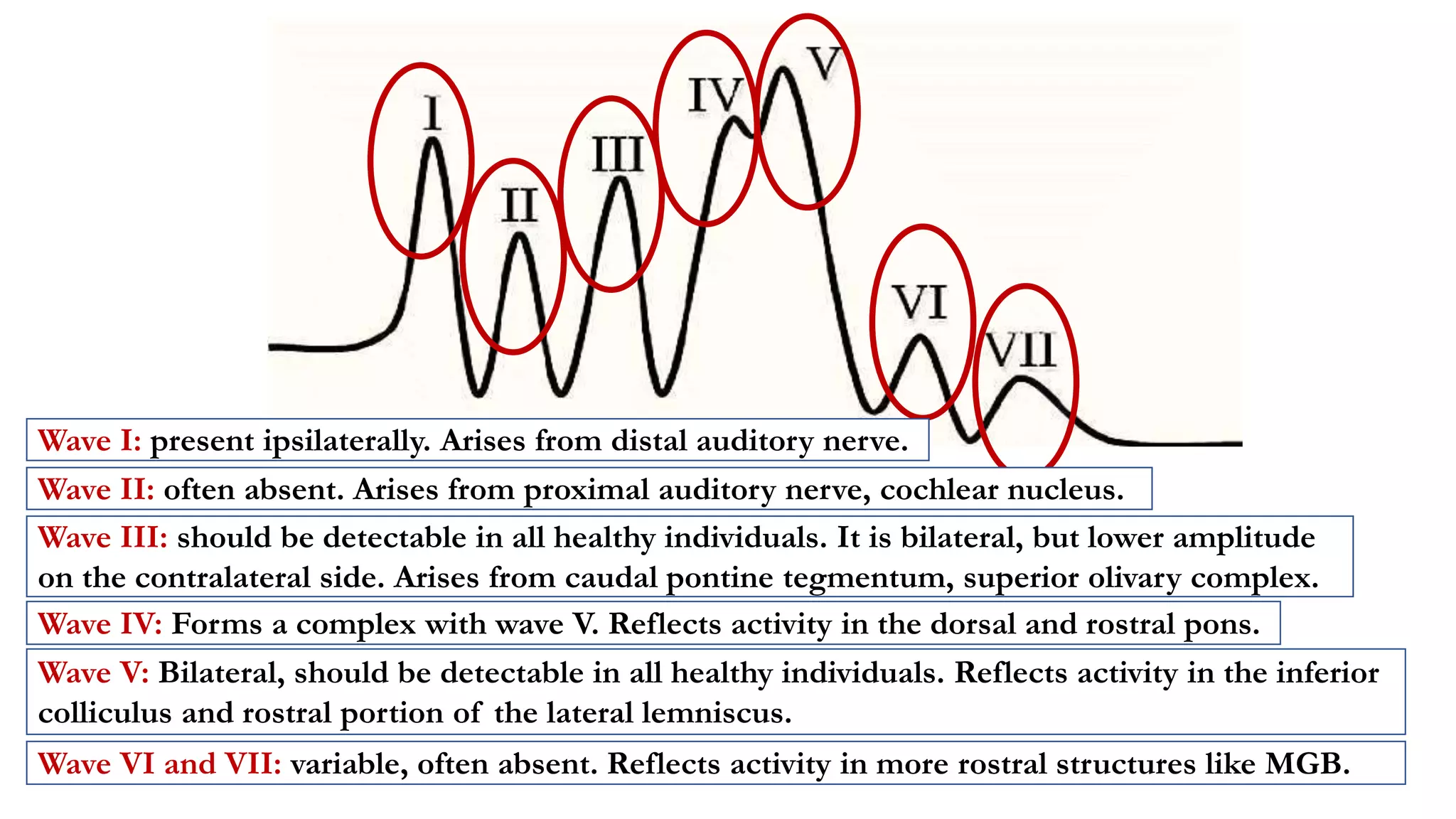 Wave II: often absent. Arises from proximal auditory nerve, cochlear nucleus.
Wave I: present ipsilaterally. Arises from distal auditory nerve.
Wave III: should be detectable in all healthy individuals. It is bilateral, but lower amplitude
on the contralateral side. Arises from caudal pontine tegmentum, superior olivary complex.
Wave IV: Forms a complex with wave V. Reflects activity in the dorsal and rostral pons.
Wave V: Bilateral, should be detectable in all healthy individuals. Reflects activity in the inferior
colliculus and rostral portion of the lateral lemniscus.
Wave VI and VII: variable, often absent. Reflects activity in more rostral structures like MGB.
 