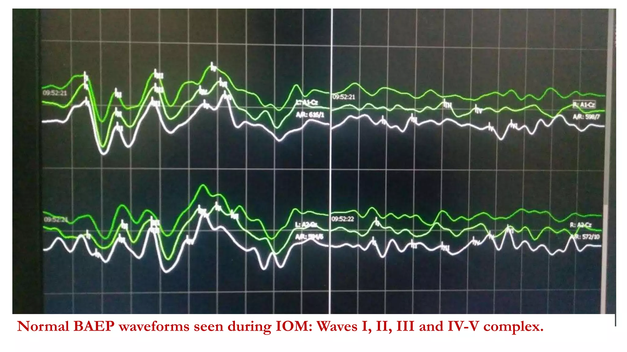 Normal BAEP waveforms seen during IOM: Waves I, II, III and IV-V complex.
 