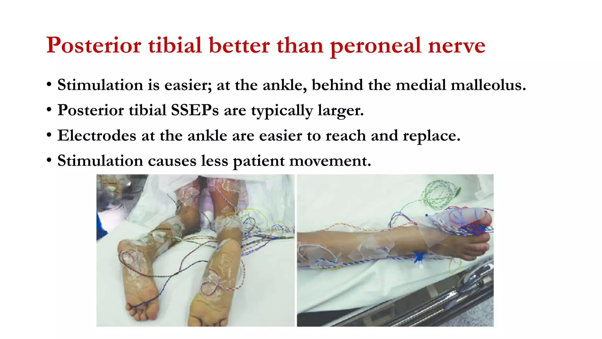 Posterior tibial better than peroneal nerve
• Stimulation is easier; at the ankle, behind the medial malleolus.
• Posterior tibial SSEPs are typically larger.
• Electrodes at the ankle are easier to reach and replace.
• Stimulation causes less patient movement.
 