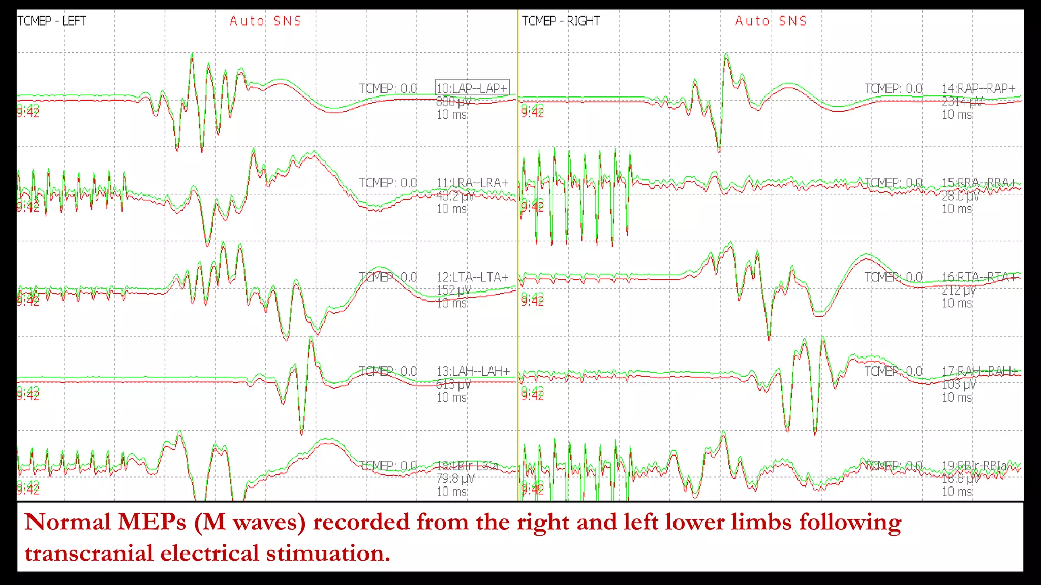 Normal MEPs (M waves) recorded from the right and left lower limbs following
transcranial electrical stimuation.
 