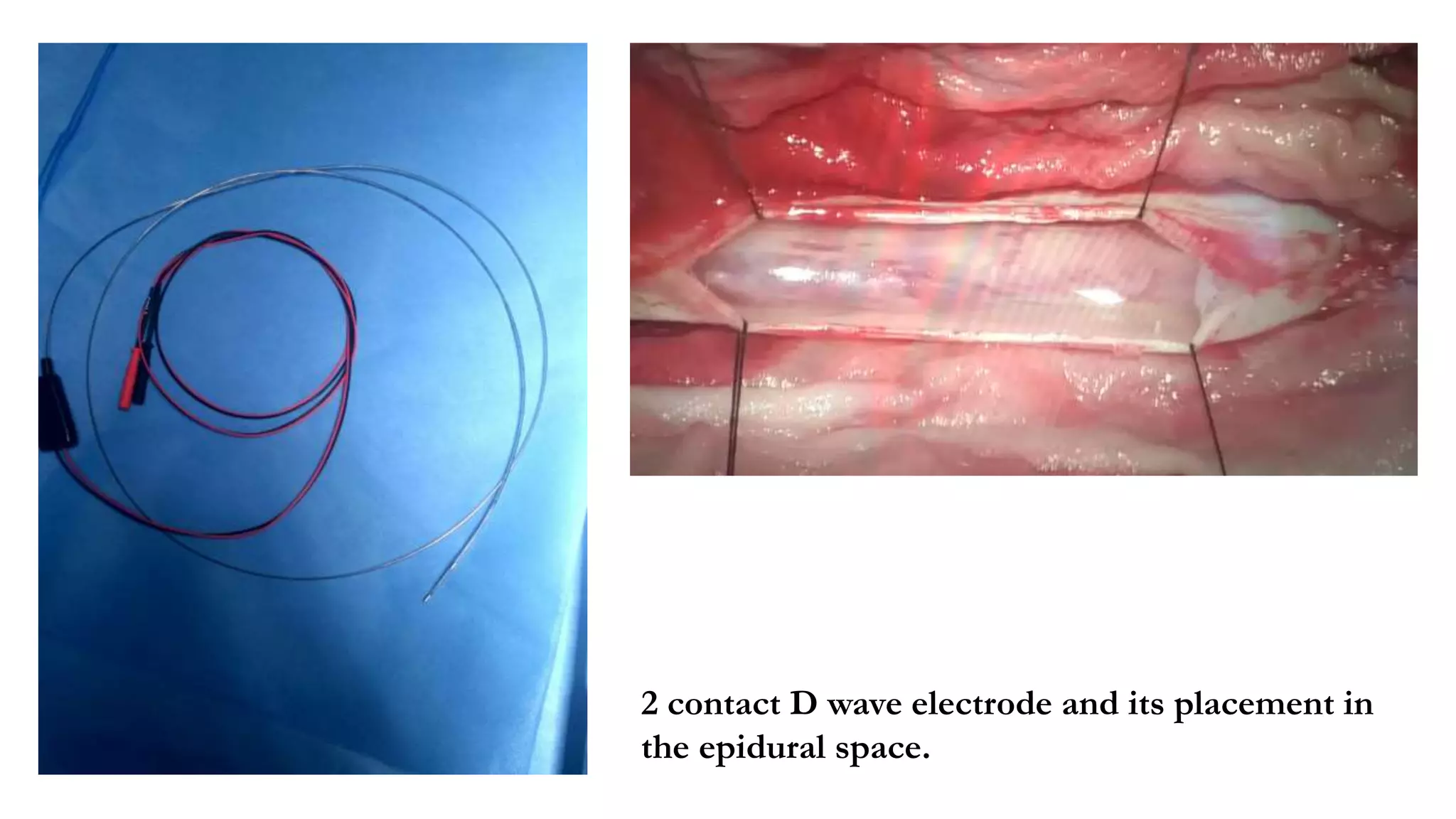 2 contact D wave electrode and its placement in
the epidural space.
 