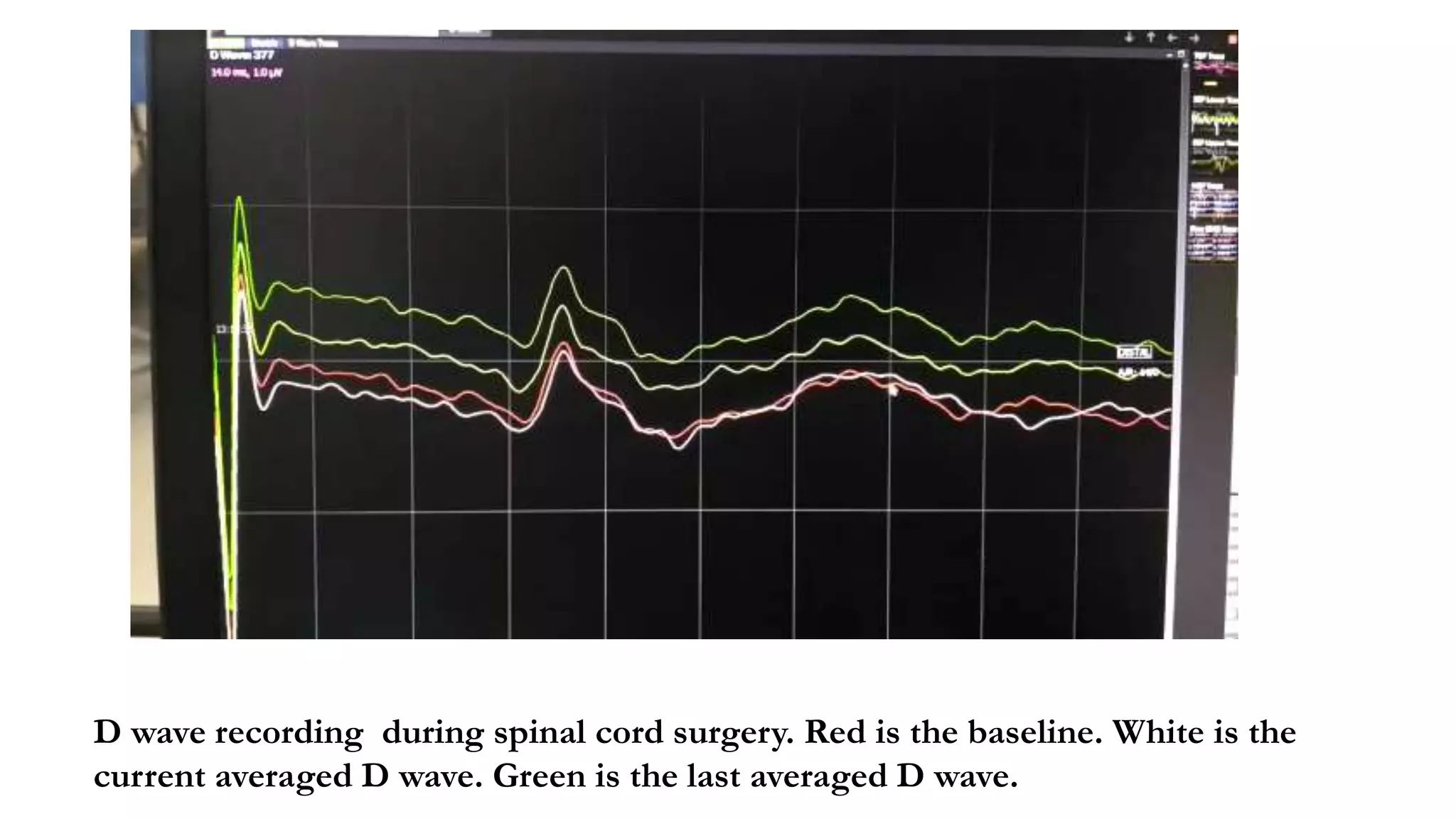 D wave recording during spinal cord surgery. Red is the baseline. White is the
current averaged D wave. Green is the last averaged D wave.
 