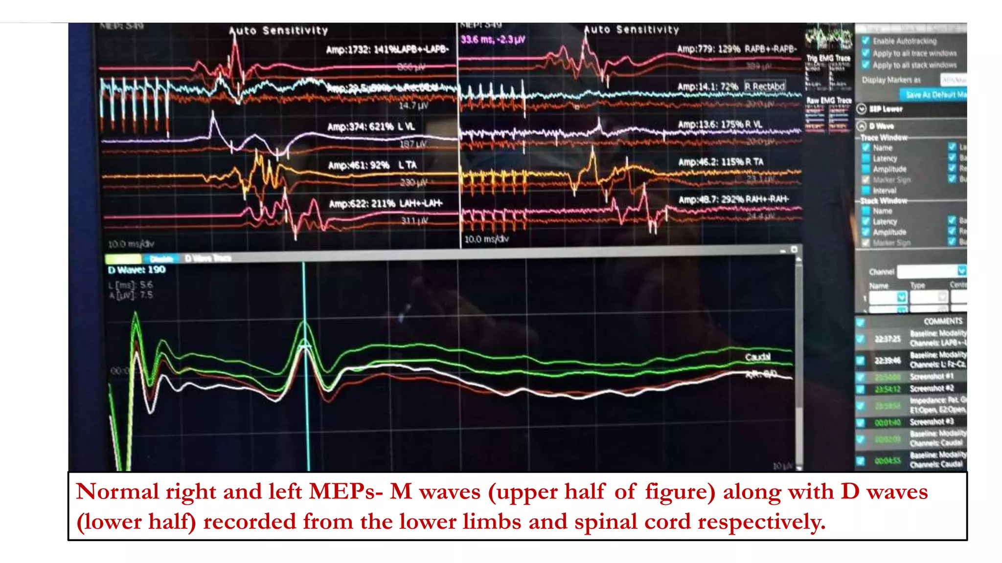 Normal right and left MEPs- M waves (upper half of figure) along with D waves
(lower half) recorded from the lower limbs and spinal cord respectively.
 