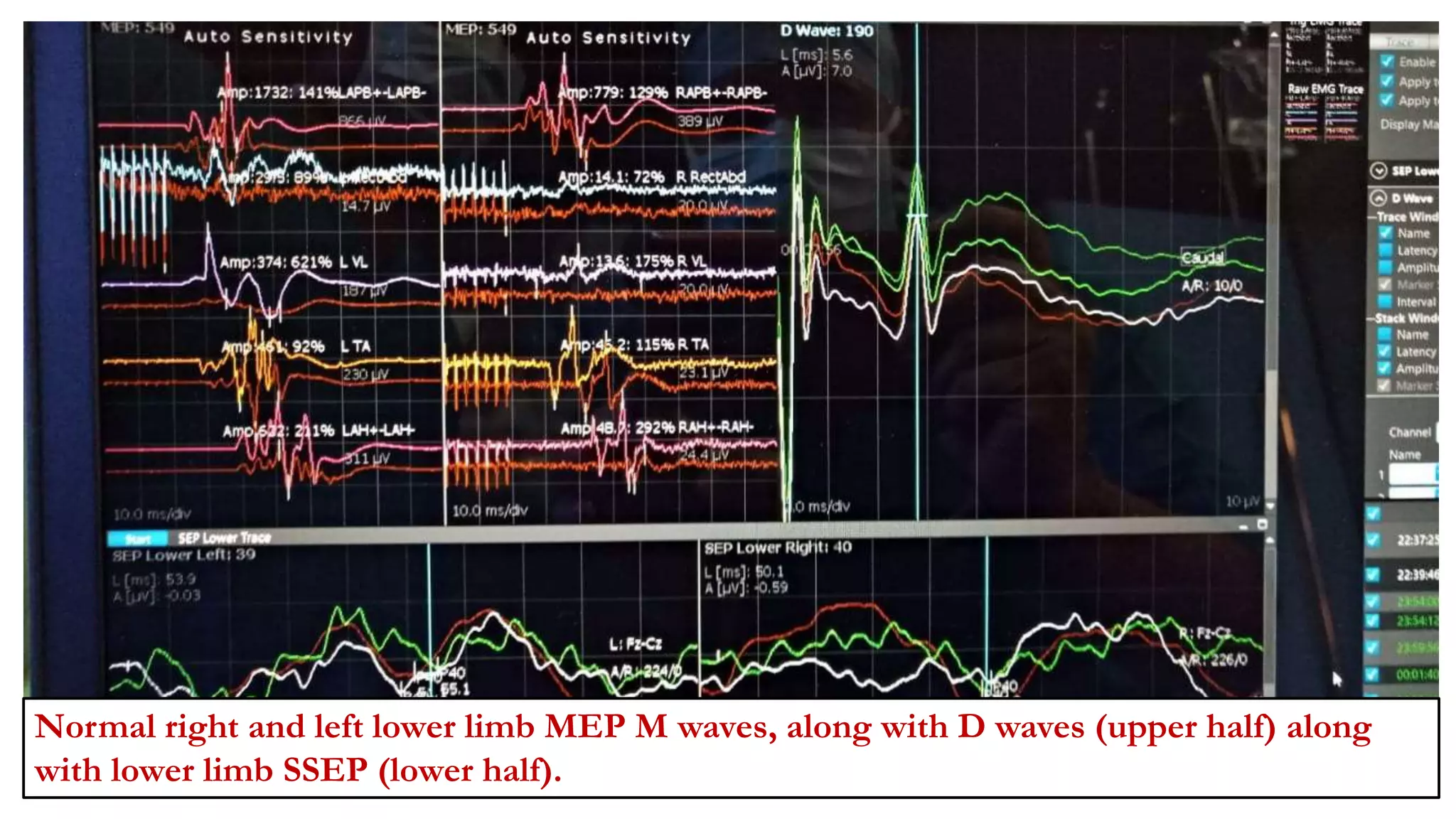 Normal right and left lower limb MEP M waves, along with D waves (upper half) along
with lower limb SSEP (lower half).
 