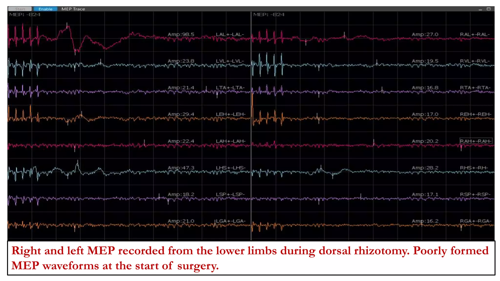 Right and left MEP recorded from the lower limbs during dorsal rhizotomy. Poorly formed
MEP waveforms at the start of surgery.
 