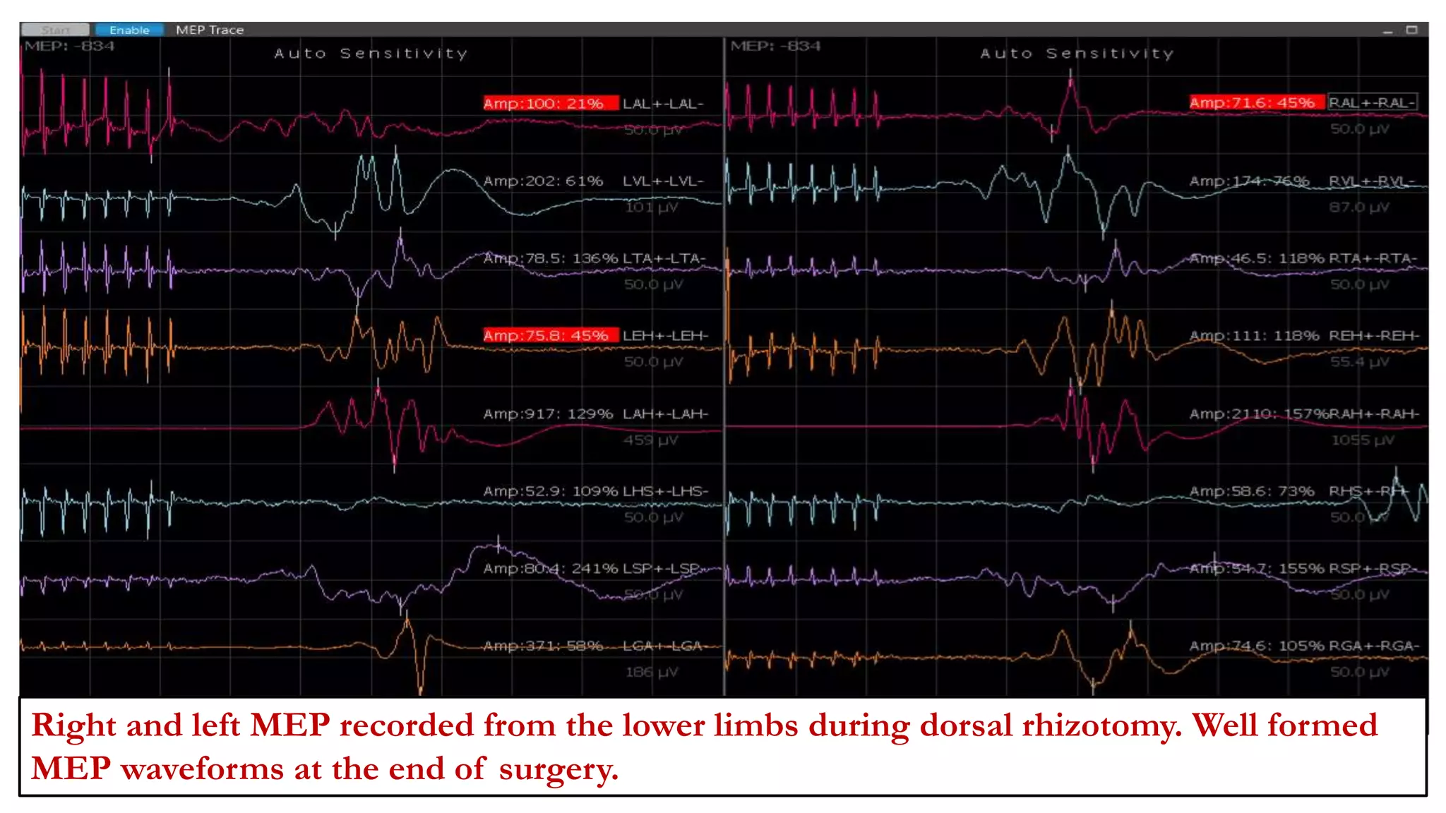 Right and left MEP recorded from the lower limbs during dorsal rhizotomy. Well formed
MEP waveforms at the end of surgery.
 
