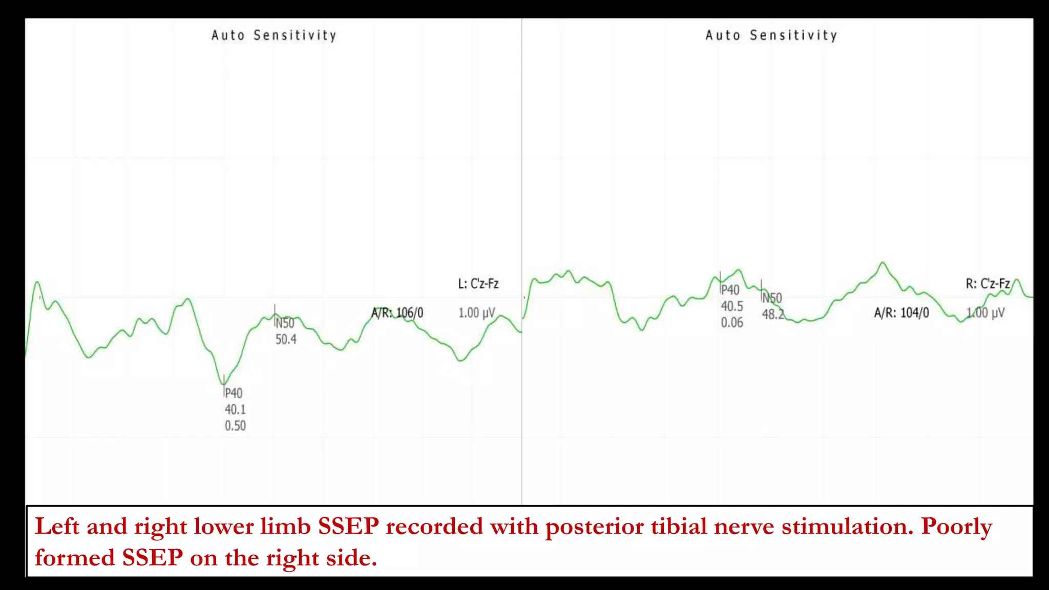 loss
Left and right lower limb SSEP recorded with posterior tibial nerve stimulation. Poorly
formed SSEP on the right side.
 