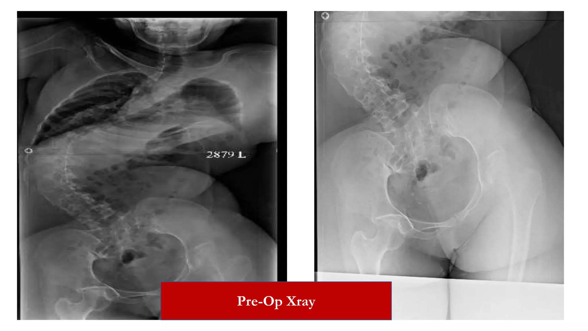 Pre-Op Xray
 