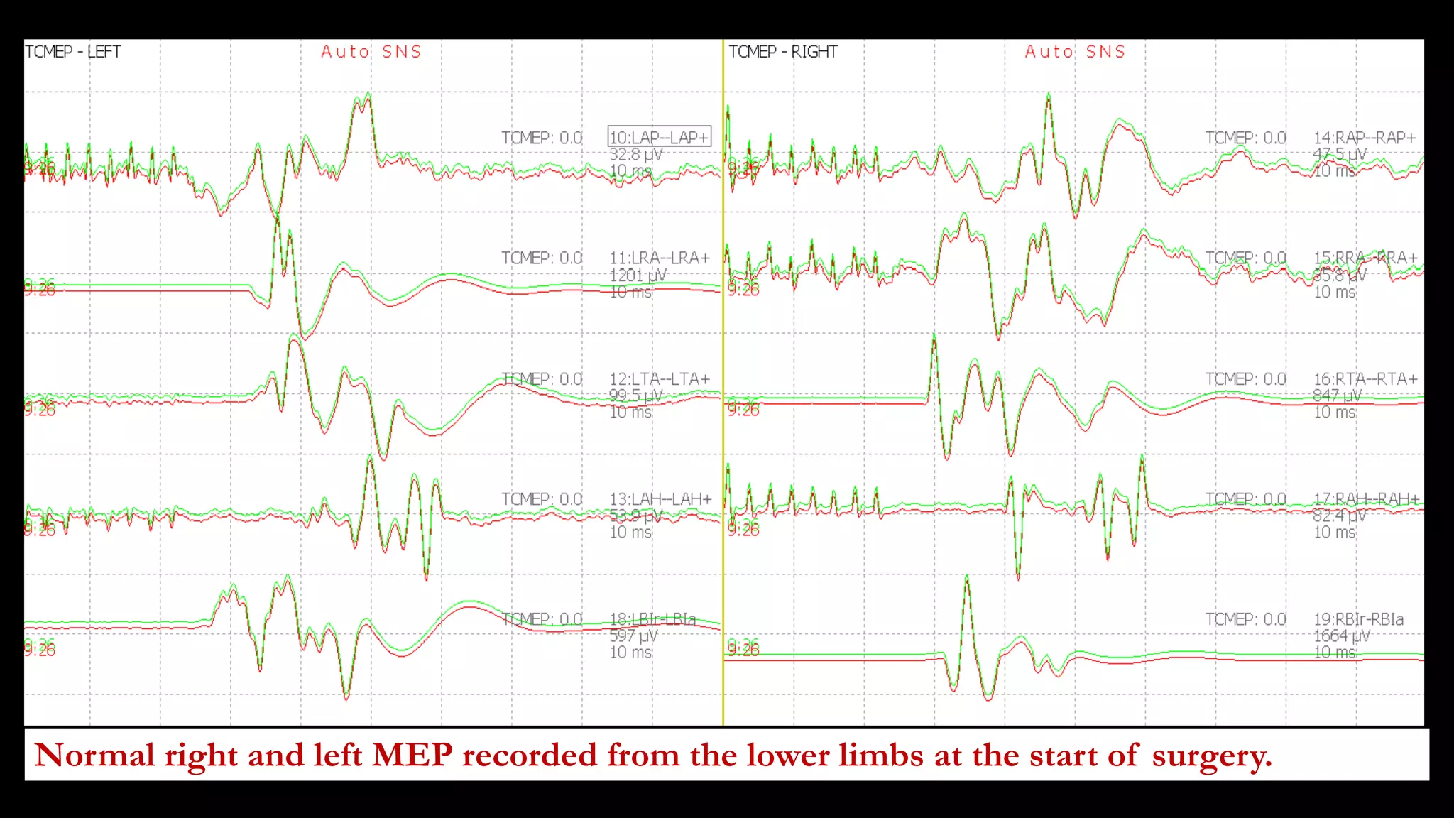 Normal right and left MEP recorded from the lower limbs at the start of surgery.
 