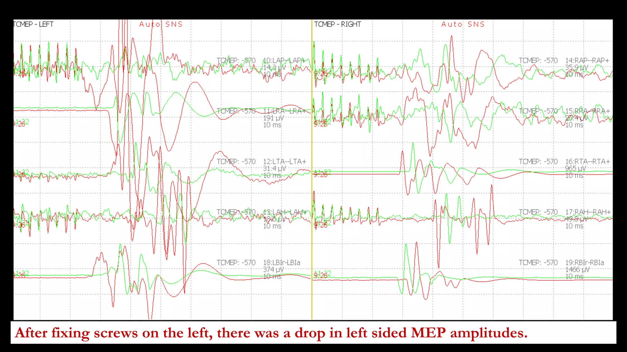 After fixing screws on the left, there was a drop in left sided MEP amplitudes.
 