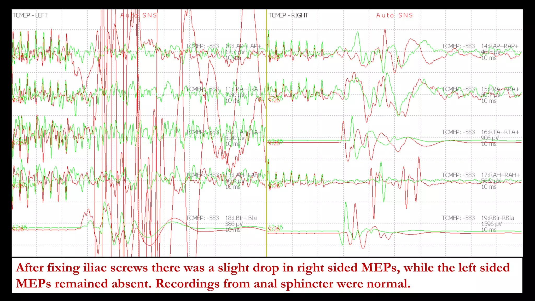After fixing iliac screws there was a slight drop in right sided MEPs, while the left sided
MEPs remained absent. Recordings from anal sphincter were normal.
 