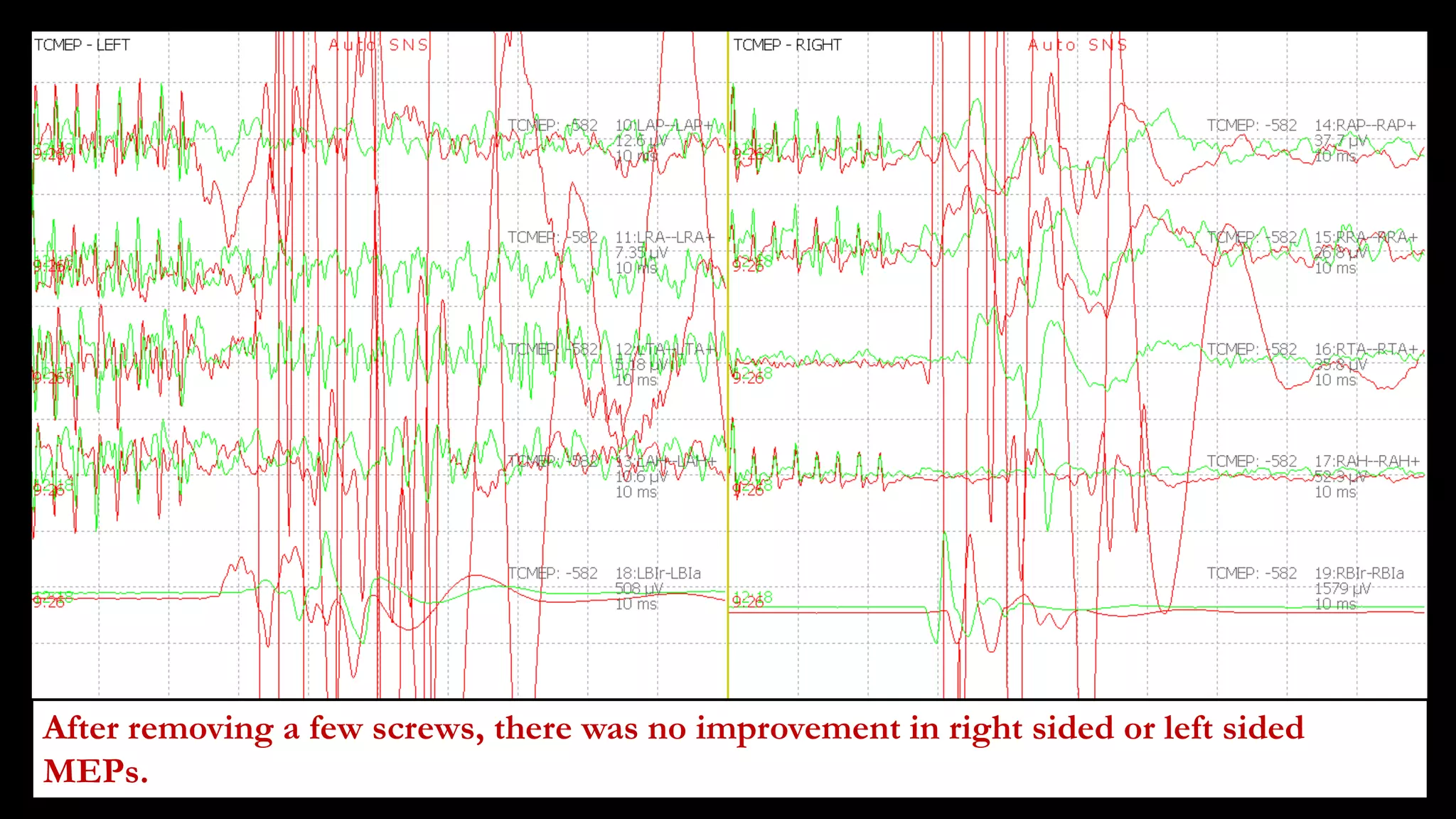 After removing a few screws, there was no improvement in right sided or left sided
MEPs.
 