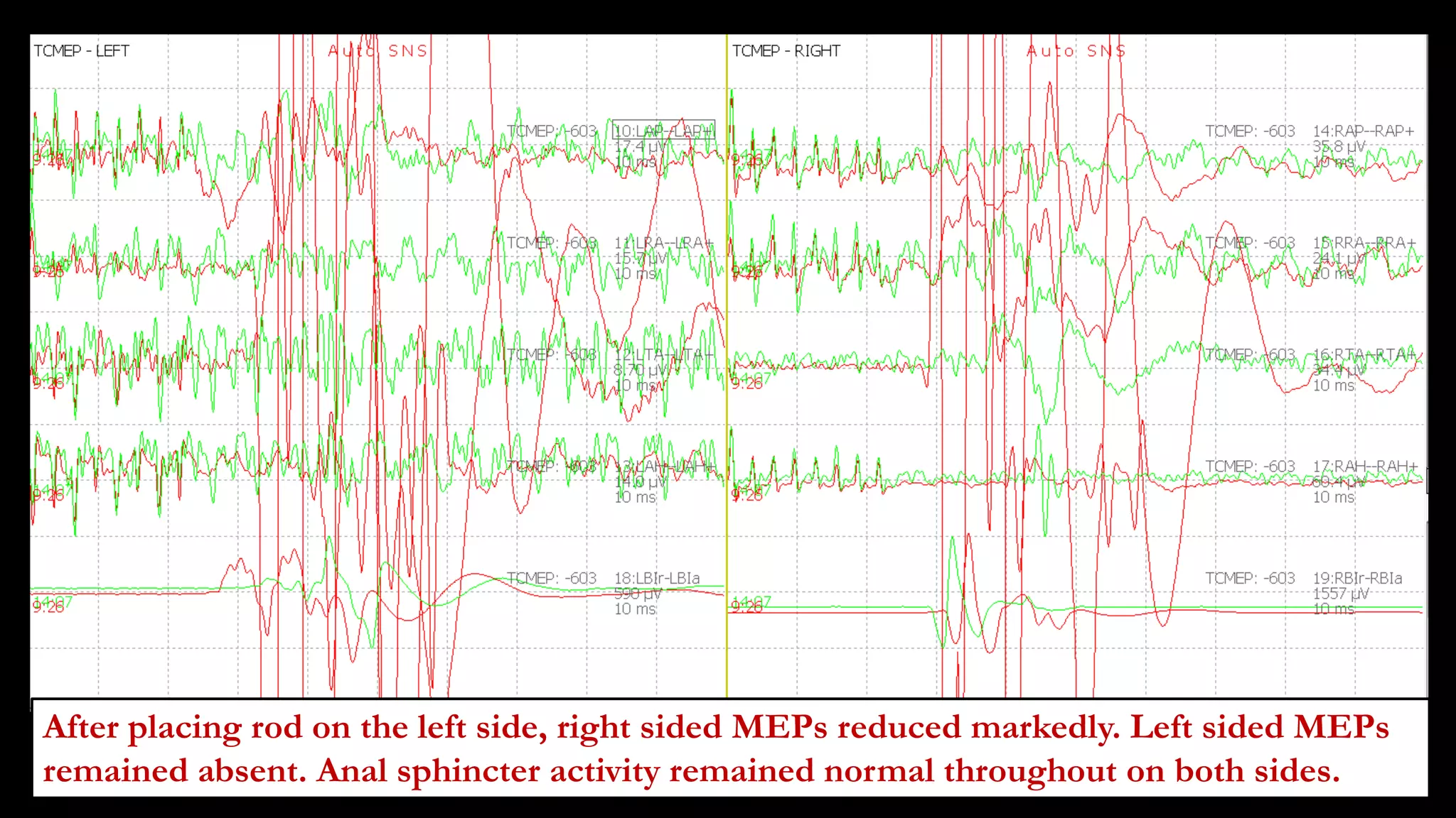 After placing rod on the left side, right sided MEPs reduced markedly. Left sided MEPs
remained absent. Anal sphincter activity remained normal throughout on both sides.
 