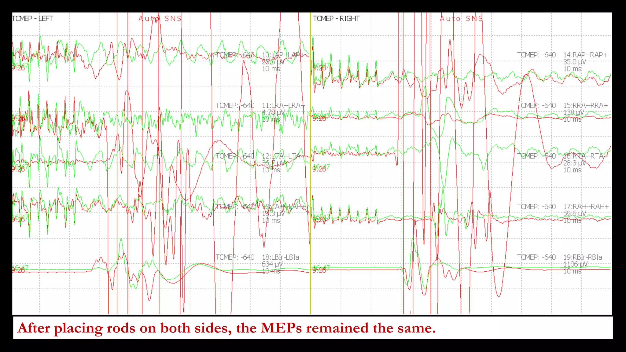 After placing rods on both sides, the MEPs remained the same.
 