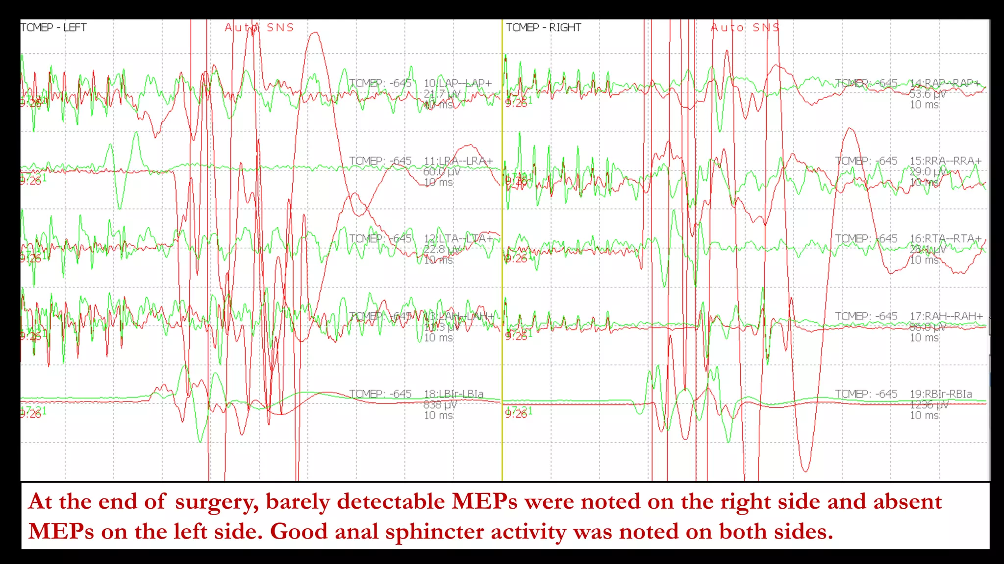 At the end of surgery, barely detectable MEPs were noted on the right side and absent
MEPs on the left side. Good anal sphincter activity was noted on both sides.
 