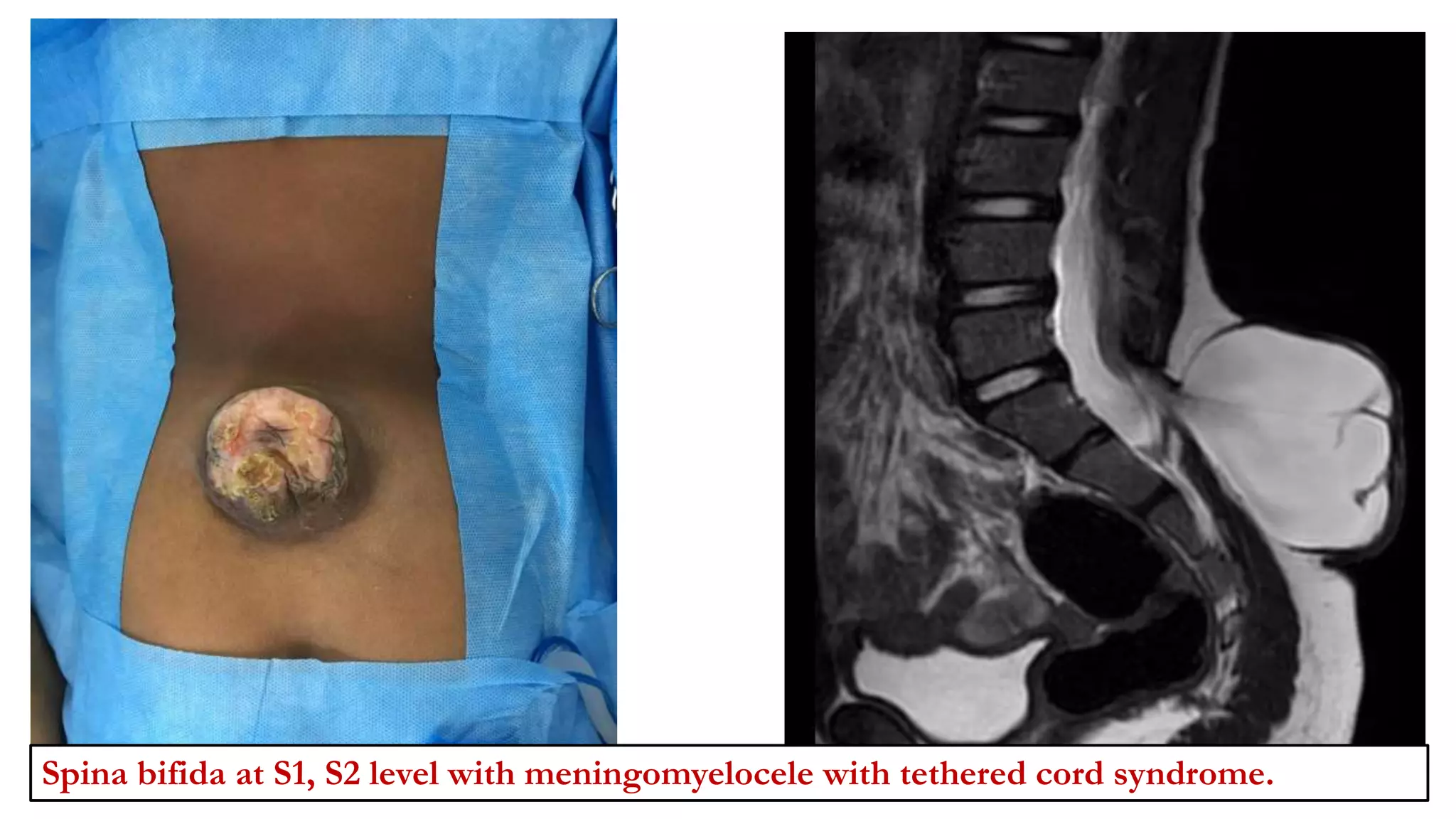 Spina bifida at S1, S2 level with meningomyelocele with tethered cord syndrome.
 