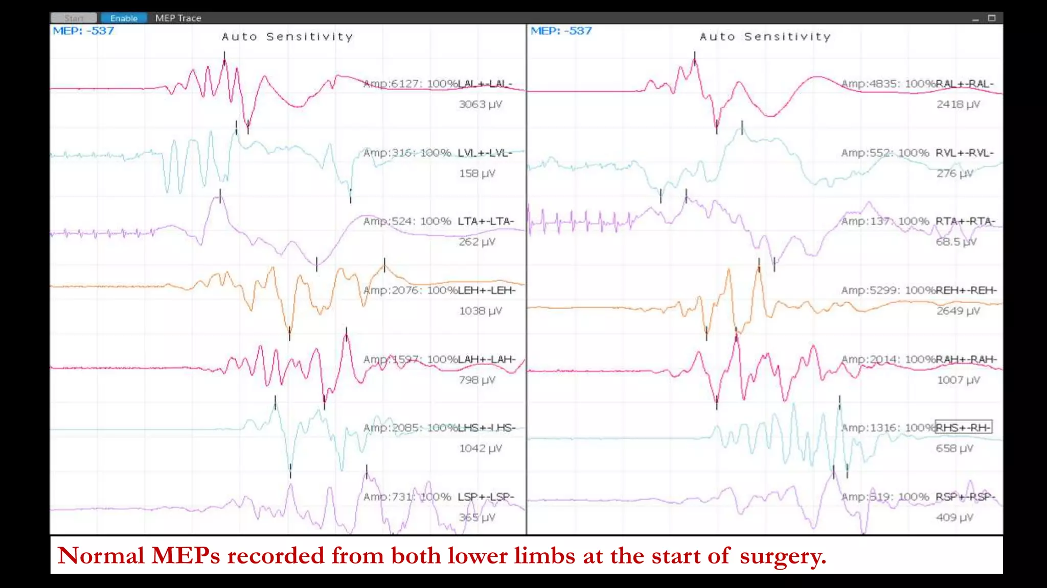 Normal MEPs recorded from both lower limbs at the start of surgery.
 