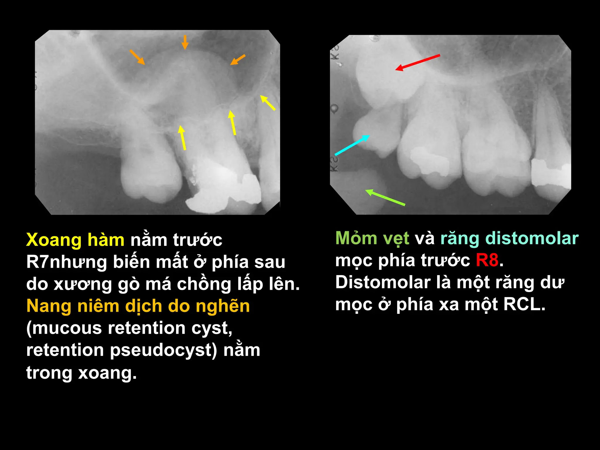 Giải phẫu X quang trong miệng (Normal Intraoral Radiographic anatomy) | PPT