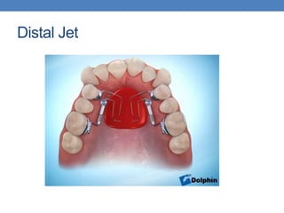 Distalisation Jet Intraoral Distalizing Devices | PPTX