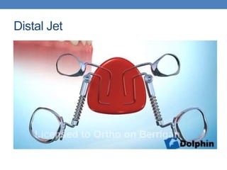 Distalisation Jet Intraoral Distalizing Devices | PPTX