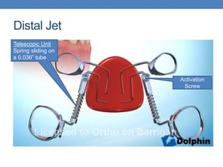 Intraoral Distalizing Devices | PPTX