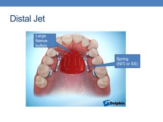 Intraoral Distalizing Devices