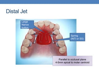 Distal Jet
Large
Nance
button
Spring
(NiTi or SS)
Parallel to occlusal plane
4-5mm apical to molar centroid
 