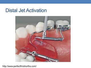 Distal Jet Activation
http://www.perfectfinishortho.com/
 