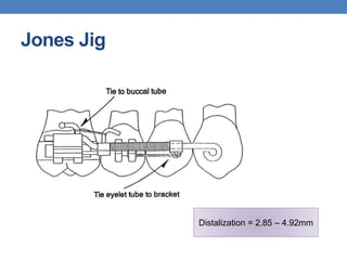 Jones Jig
Distalization = 2.85 – 4.92mm
 
