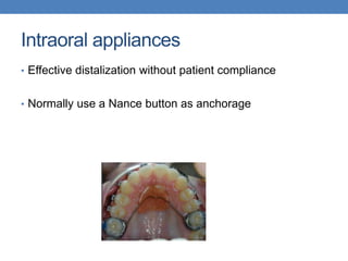 Intraoral appliances
• Effective distalization without patient compliance
• Normally use a Nance button as anchorage
 