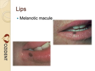 how to store lipo c peptide Disorders with increased pigmentation (hypermelanosis)