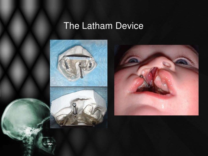 mouth opening problem Prosthetics Intraoral mouth opening problem Prosthetics Intraoral