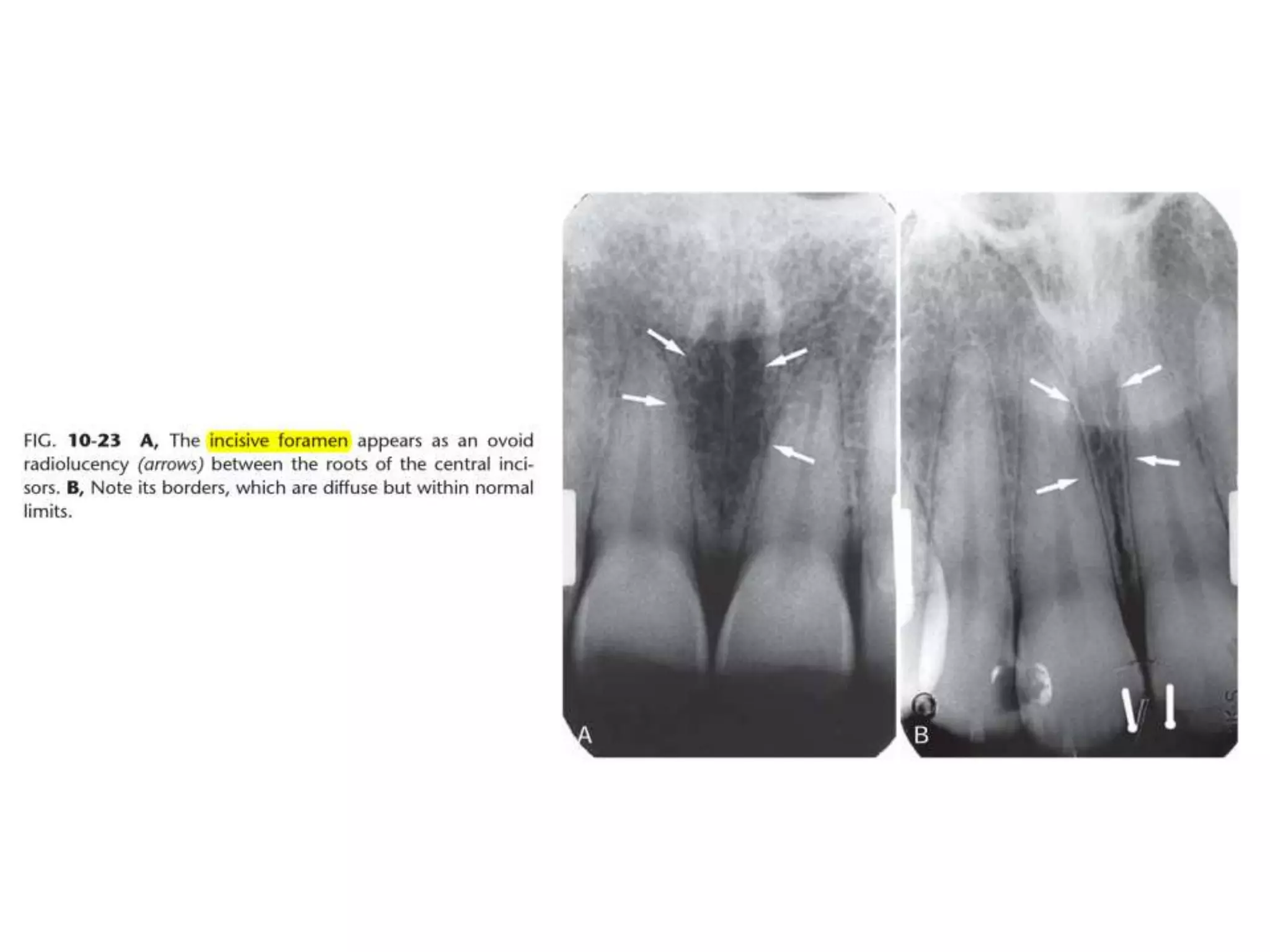 Intraoral radiographic anatomy | PPTX