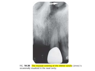 Intraoral radiographic anatomy