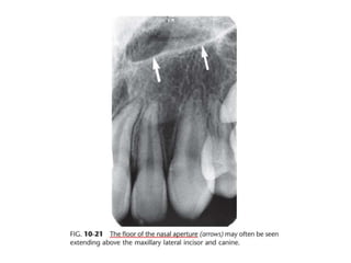 Intraoral radiographic anatomy