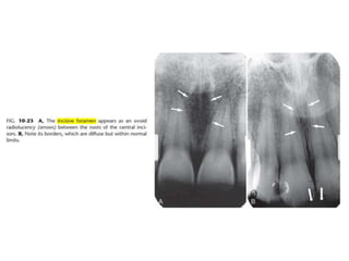 Intraoral radiographic anatomy