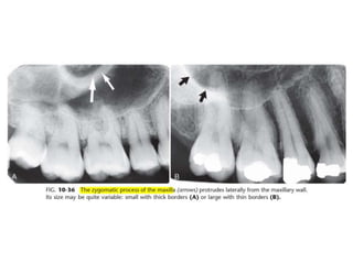 Intraoral radiographic anatomy