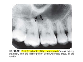 Intraoral radiographic anatomy