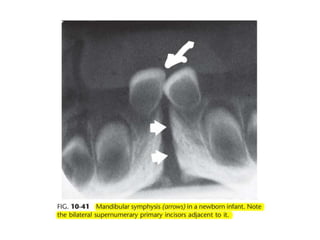 Intraoral radiographic anatomy