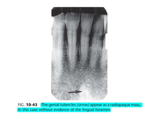 Intraoral radiographic anatomy
