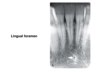 Intraoral radiographic anatomy