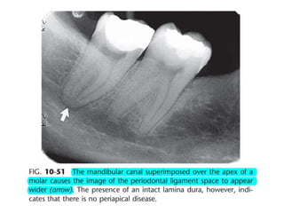 Intraoral radiographic anatomy