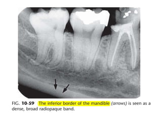 Intraoral radiographic anatomy