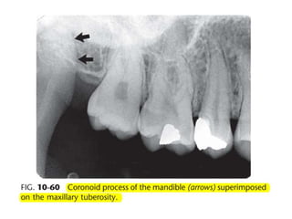 Intraoral radiographic anatomy