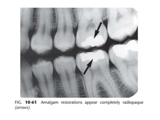 Intraoral radiographic anatomy